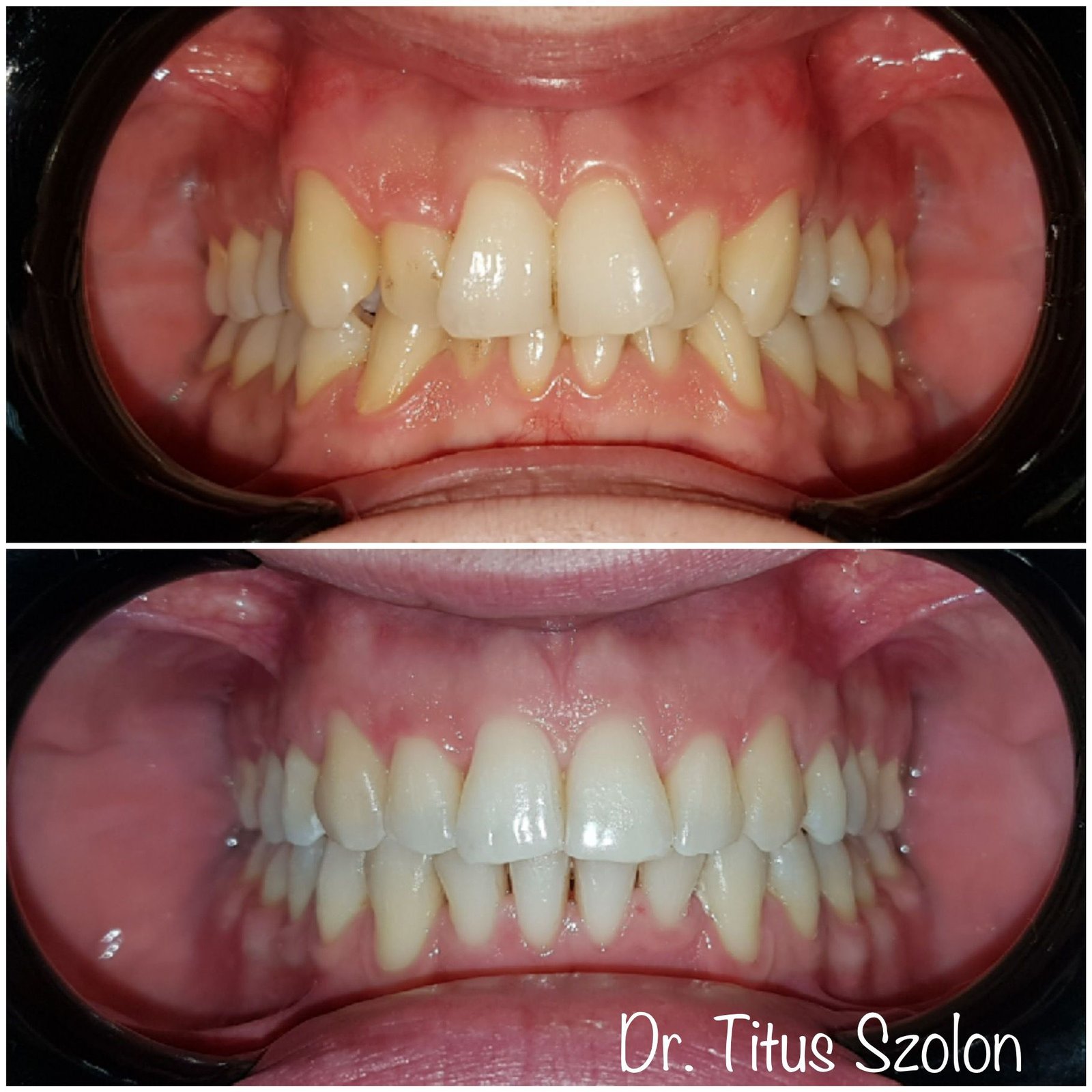 Aliniere dentară după tratament ortodontic cu aparat fix | Utopia Dental Bistrița