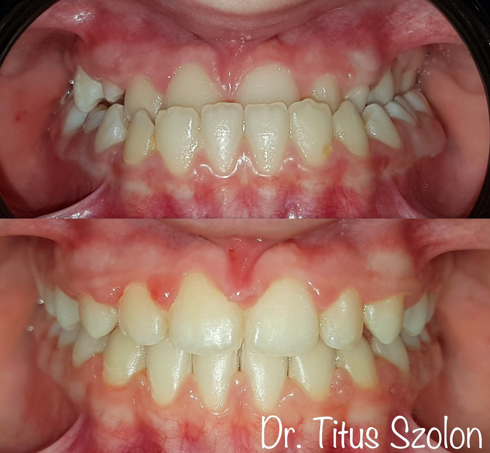 Caz ortodontic tratat cu aparat dentar fix – înainte și după | Utopia Dental Bistrița