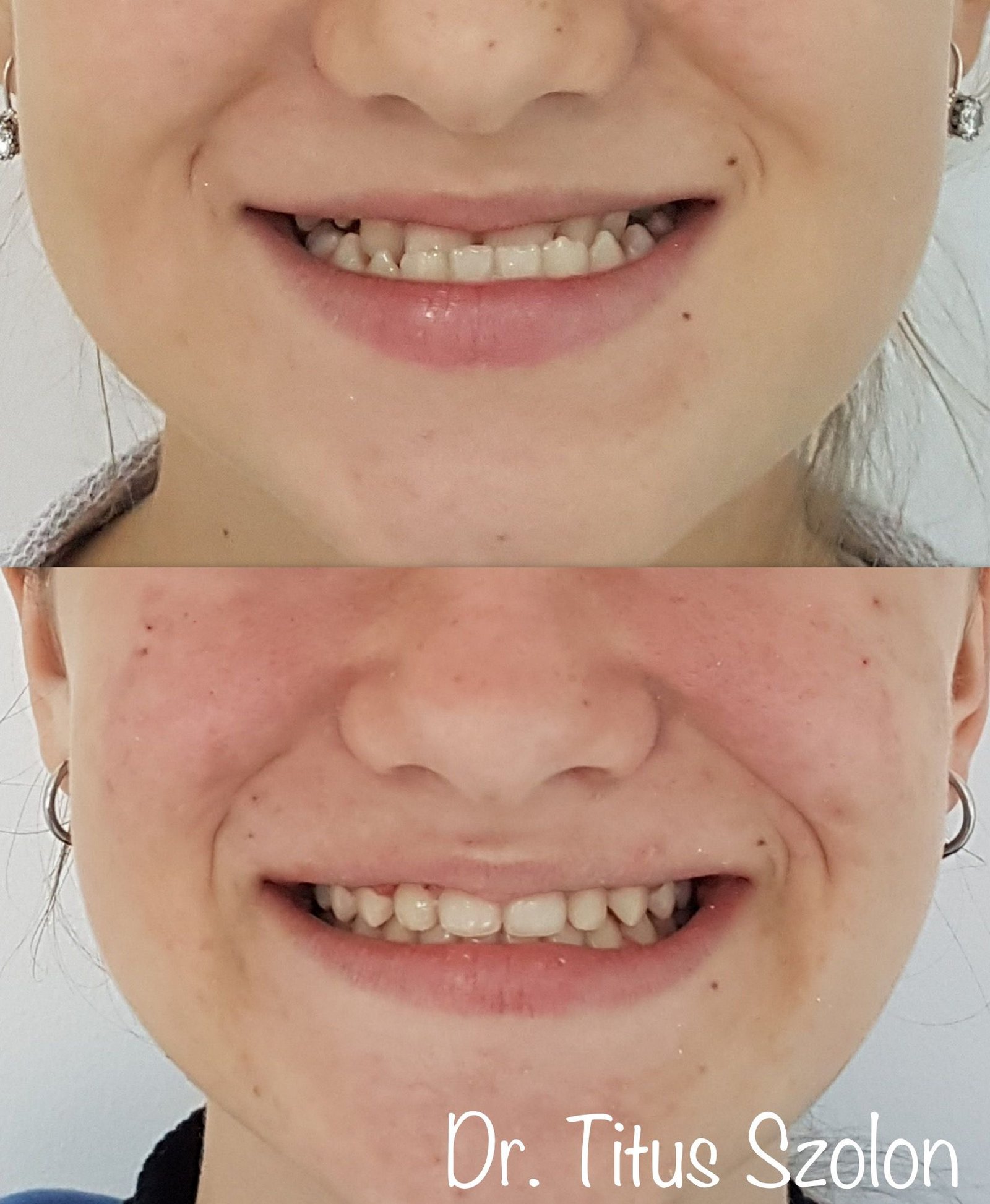 Caz ortodontic tratat cu aparat dentar fix – înainte și după | Utopia Dental Bistrița