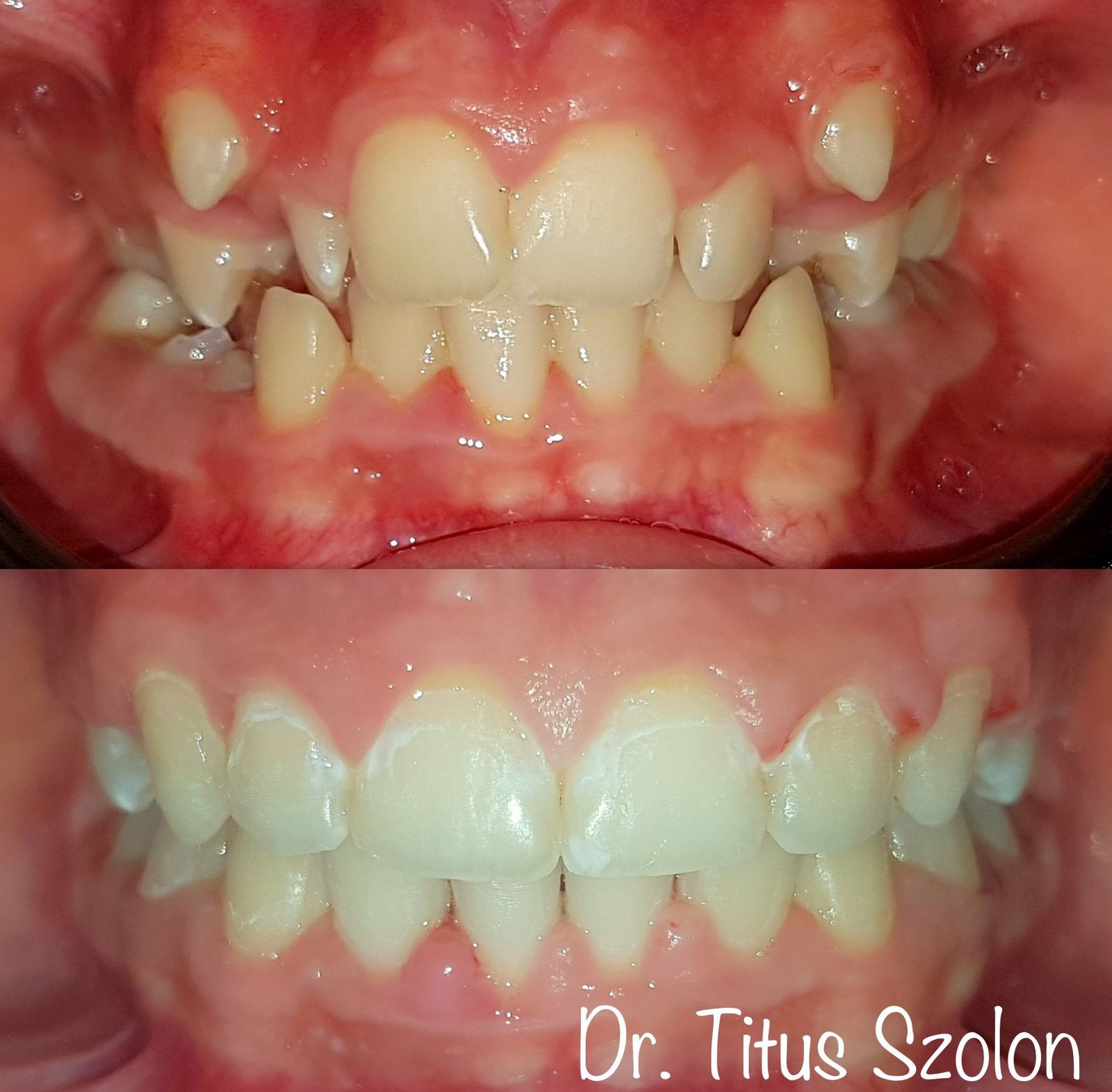 Aliniere dentară după tratament ortodontic cu aparat fix | Utopia Dental Bistrița