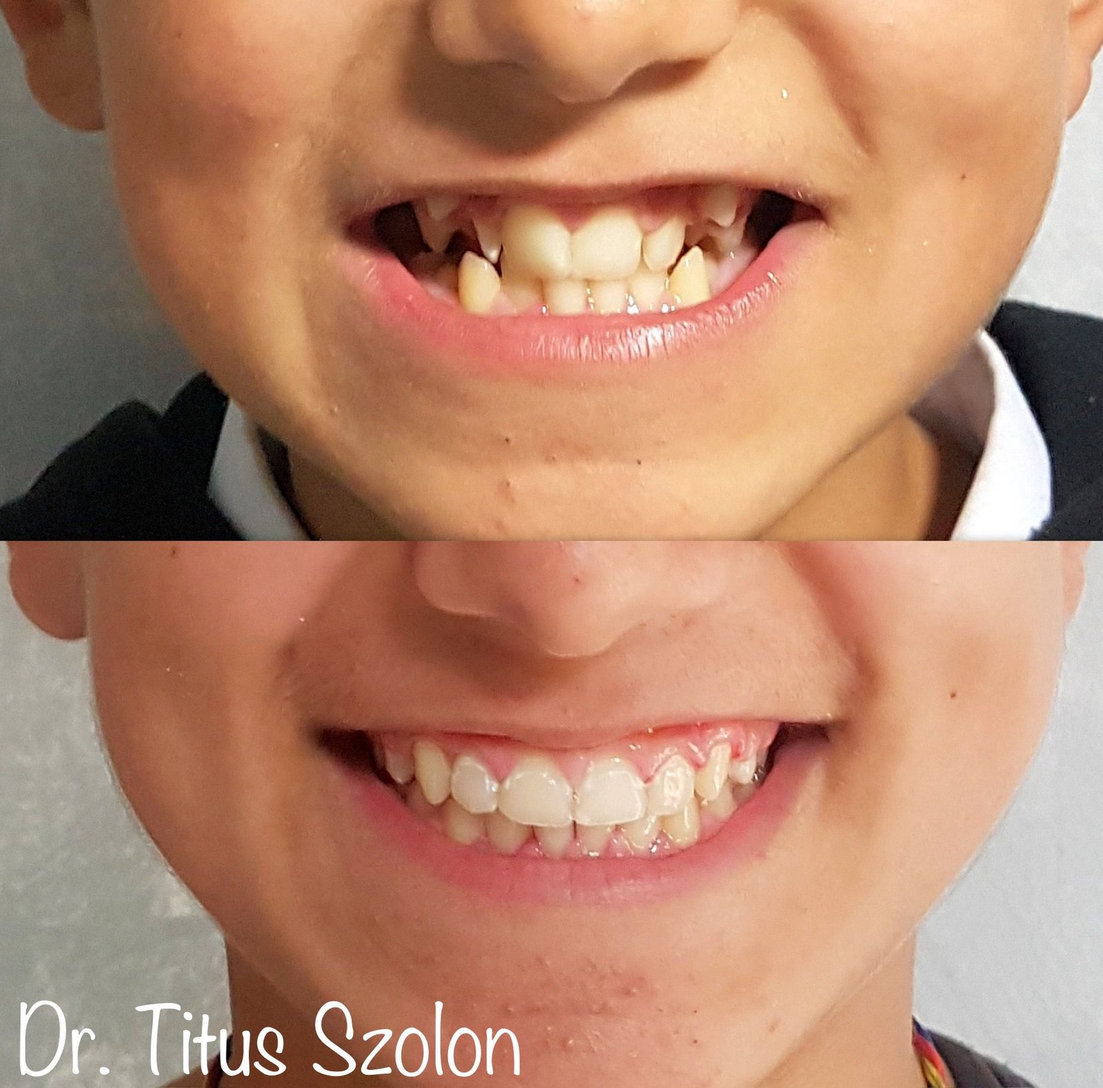 Caz ortodontic tratat cu aparat dentar fix – înainte și după | Utopia Dental Bistrița