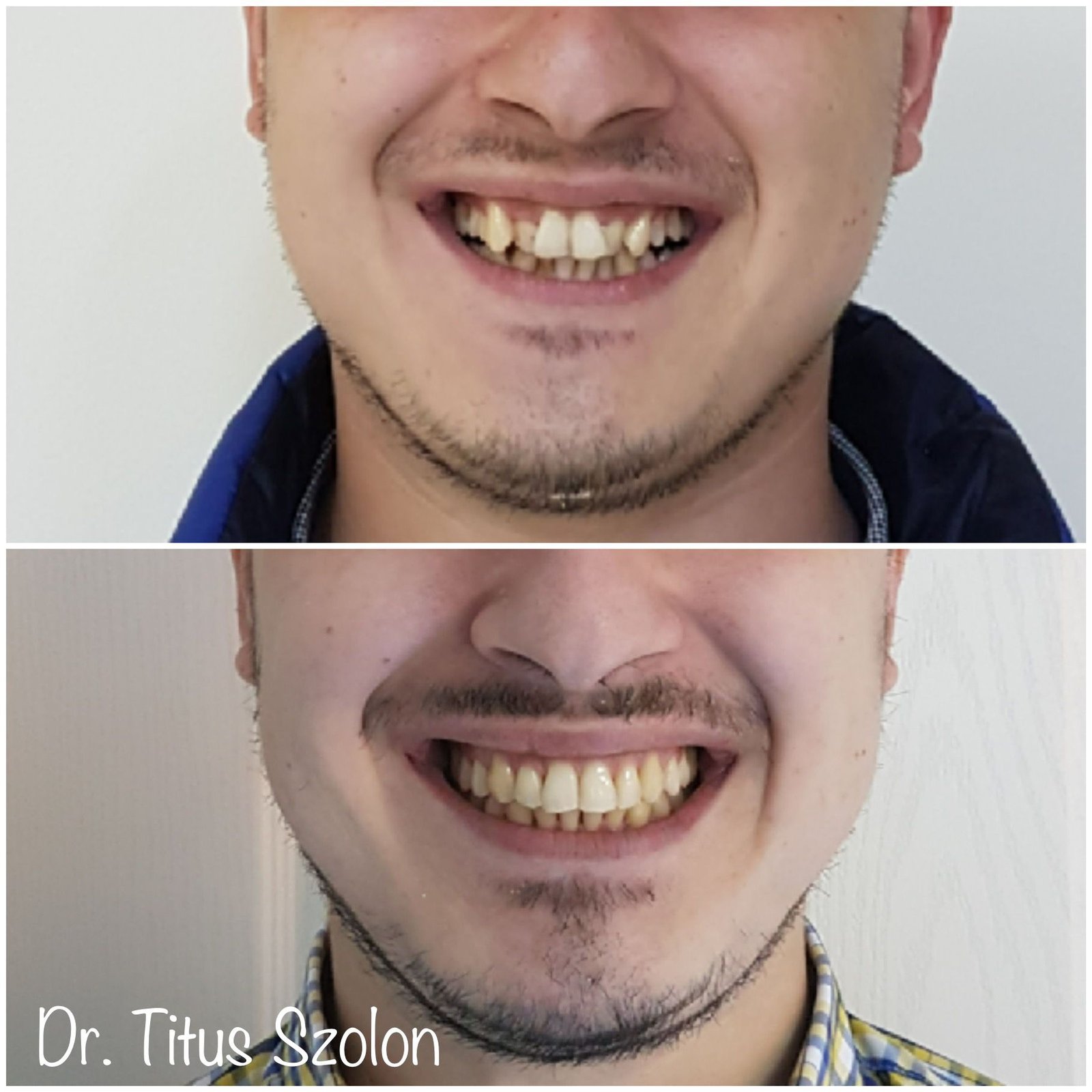 Caz ortodontic tratat cu aparat dentar fix – înainte și după | Utopia Dental Bistrița
