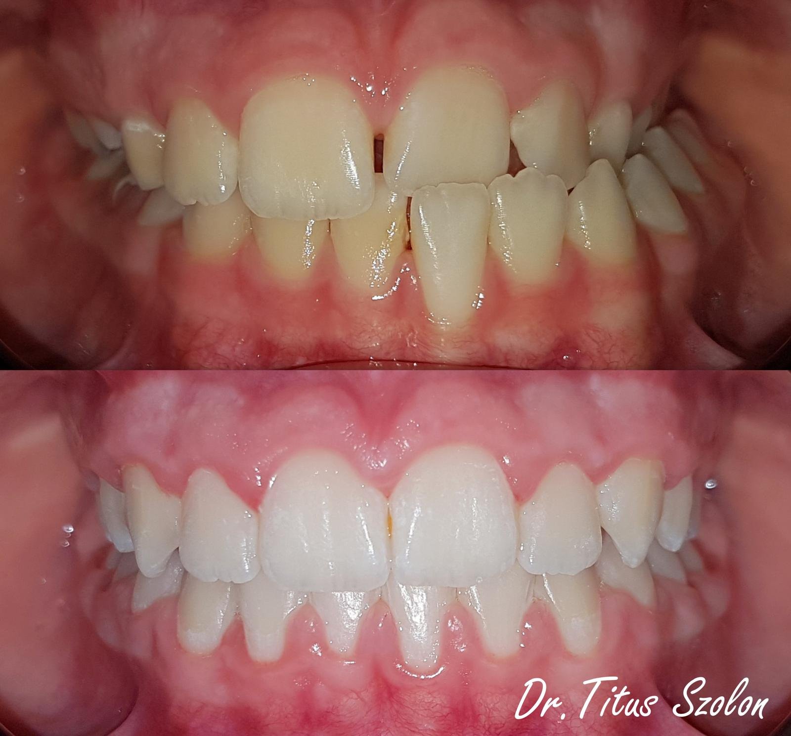 Rezultat tratament ortodontic cu aparat dentar fix | Utopia Dental Bistrița