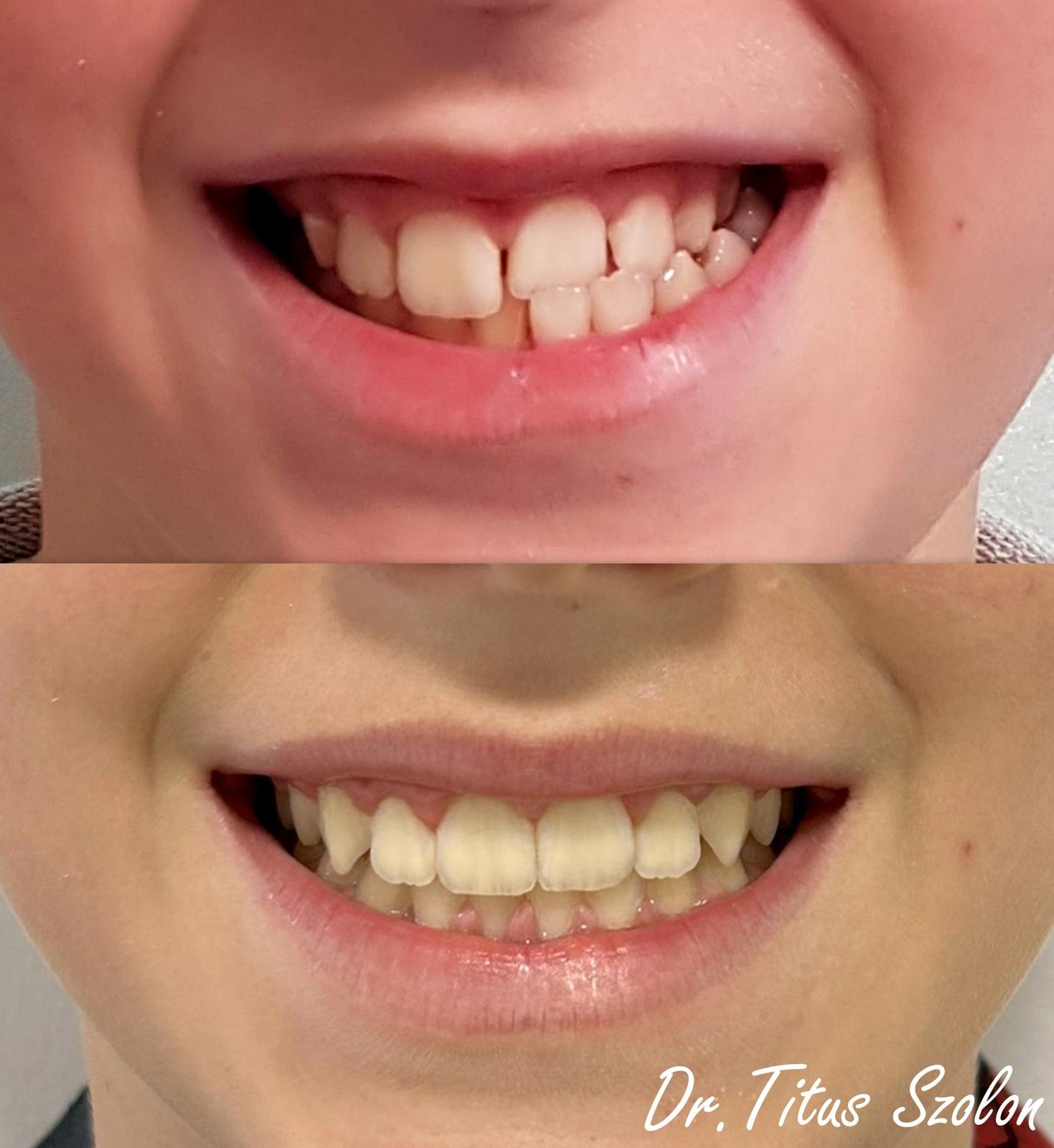 Caz ortodontic tratat cu aparat dentar fix – înainte și după | Utopia Dental Bistrița