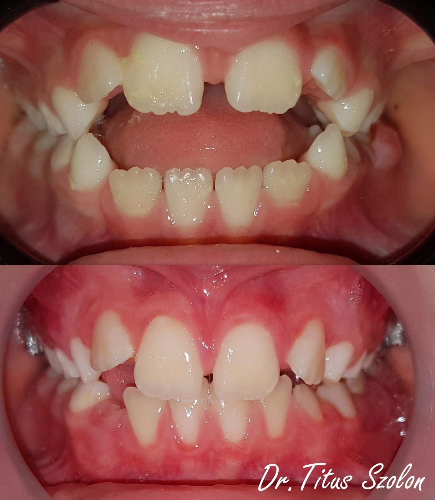 Rezultat tratament ortodontic cu aparat fix – înainte și după | Utopia Dental Bistrița