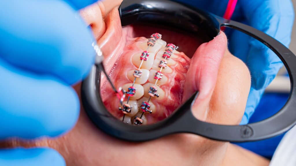 Aparat dentar fix în timpul tratamentului ortodontic – Utopia Dental Bistrița
