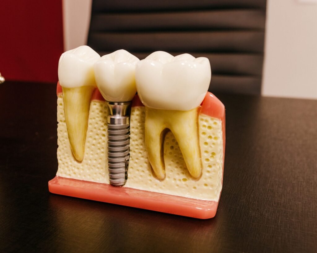 Ceramic dental implants with bolt in artificial mouth piece on desktop in hospital